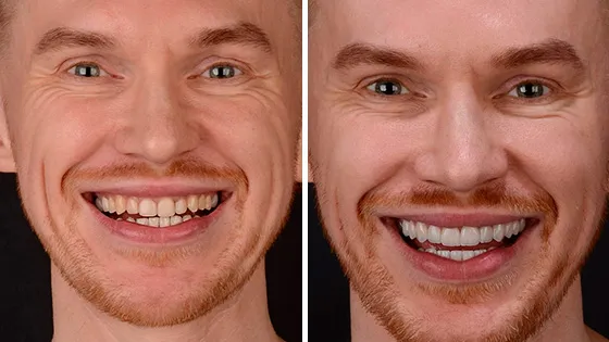 Implantes e Facetas no Padrão Internacional.